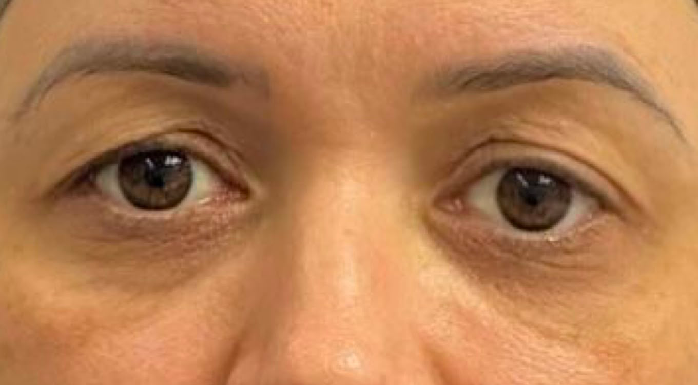 Antes da blefaroplastia
